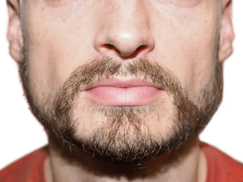 Man with full beard. Considering hair restoration? See beard density options & transplant results. Before & after consultation available.