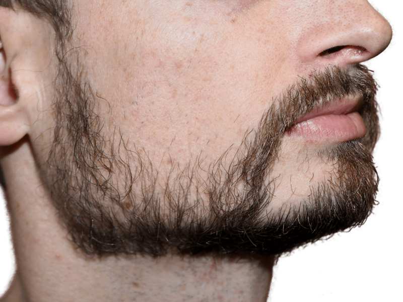 Full, dark beard on light-skinned man. Example of beard hair before hair restoration or transplant procedures.