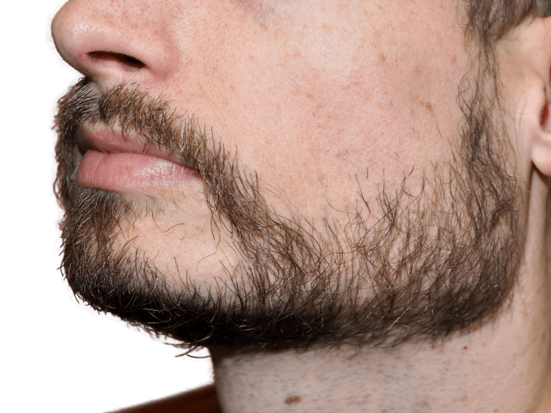 Patchy beard with brown & gray hairs. Consider beard hair transplant for fuller coverage. Before hair restoration options.