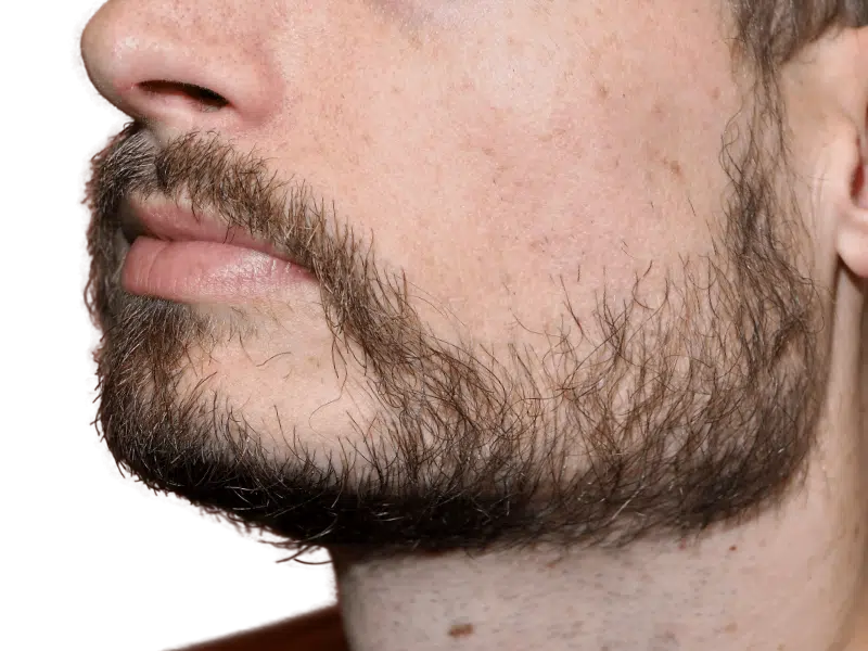 Patchy beard with brown & gray hairs. Consider beard hair transplant for fuller coverage. Before hair restoration options.