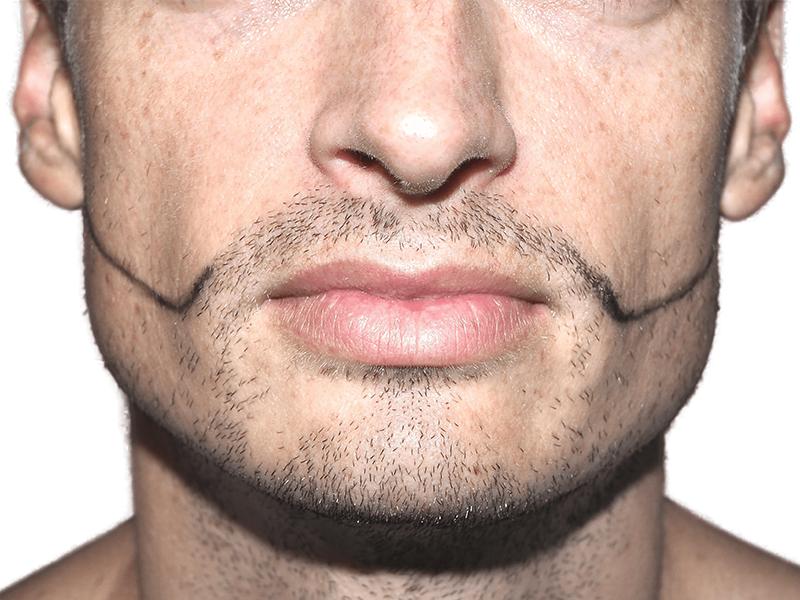 Beard transplant planning. Man with marked beard area for hair restoration. Visualize your beard transplant results.