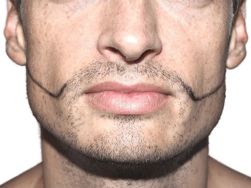 Beard transplant planning. Man with marked beard area for hair restoration. Visualize your beard transplant results.