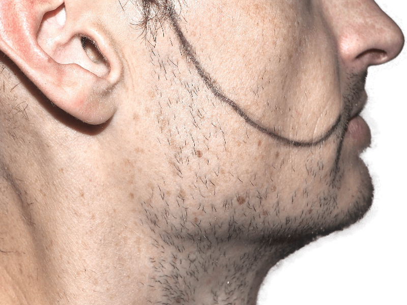 Beard transplant planning. Man with sparse facial hair marked for hair restoration. Potential beard line shown.