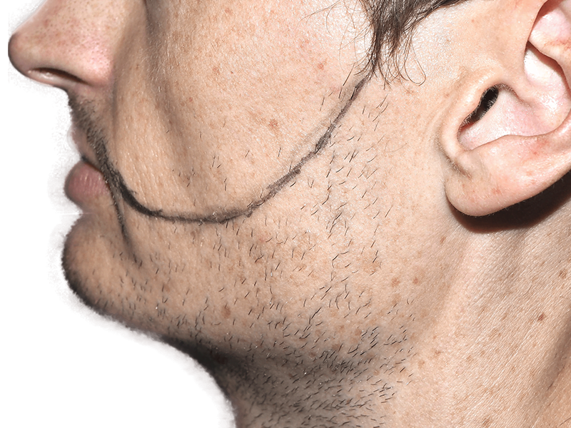 Man marked for hair transplant. Side view showing area for potential hair restoration procedure. Before assessment.