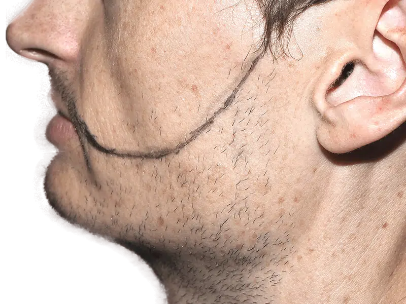 Man marked for hair transplant. Side view showing area for potential hair restoration procedure. Before assessment.
