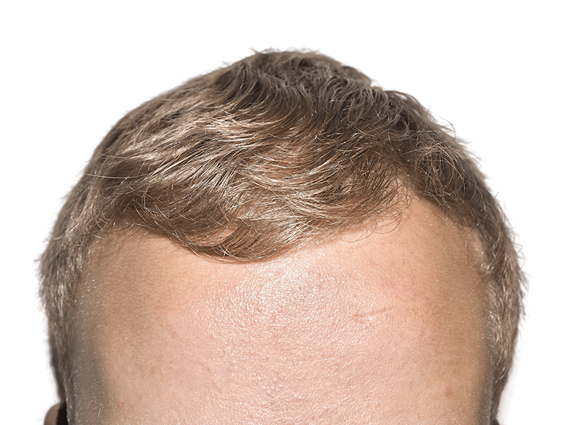 Hair transplant result: Light brown hair, receding hairline, and visible scar. Potential hair restoration before/after.