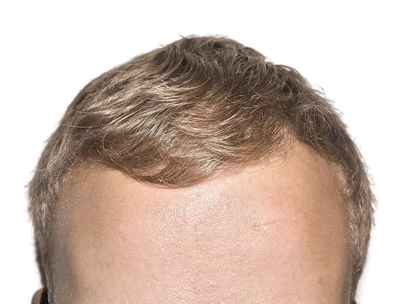 Hair transplant result: Light brown hair, receding hairline, and visible scar. Potential hair restoration before/after.