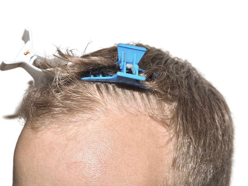 Thinning light brown hair. Possible hair loss before restoration. Hair clips visible. Forehead skin detail.