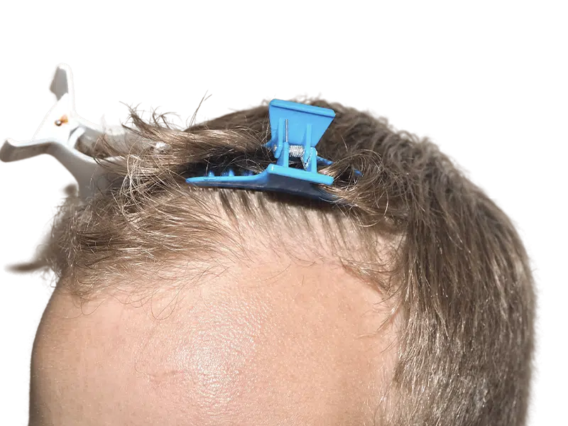 Thinning light brown hair. Possible hair loss before restoration. Hair clips visible. Forehead skin detail.