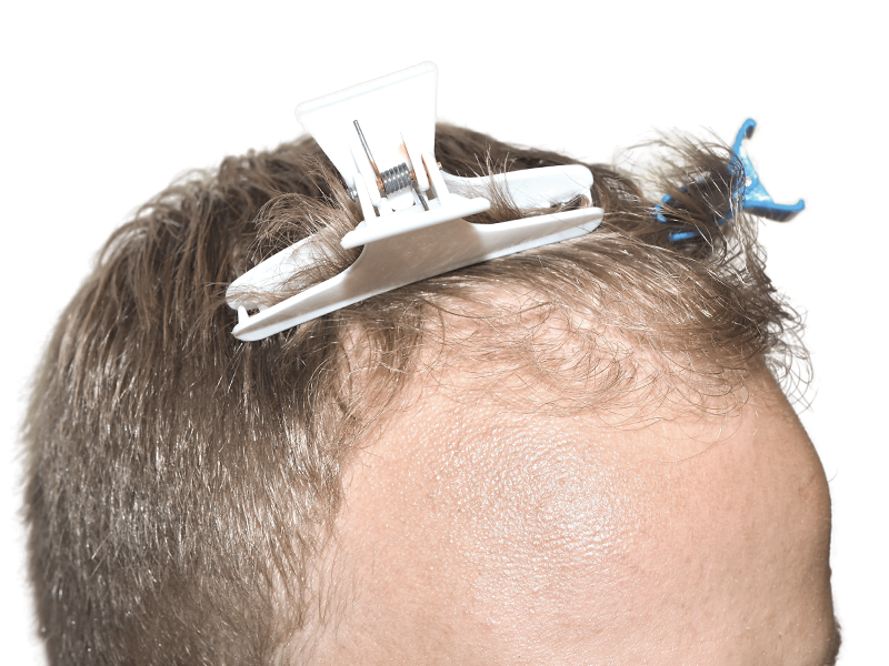 Hair transplant prep: Man with receding hairline, hair clips holding sections for restoration procedure.
