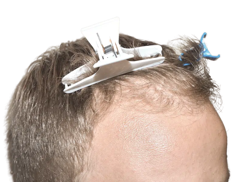 Hair transplant prep: Man with receding hairline, hair clips holding sections for restoration procedure.