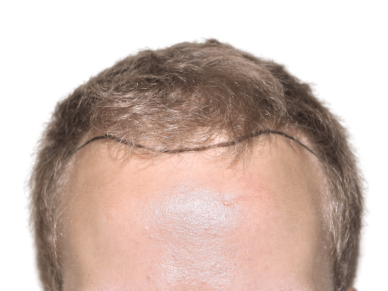 Hair transplant consultation: Marked hairline shows planned restoration area. Sparse hair indicates before treatment.