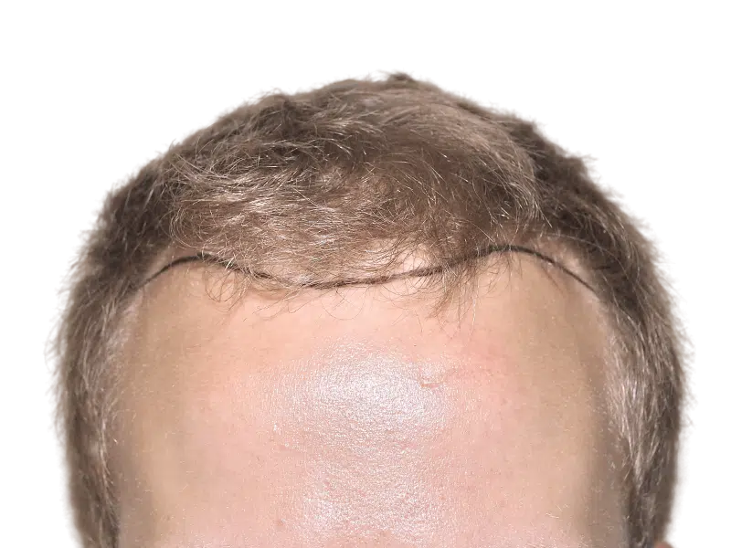 Hair transplant consultation: Marked hairline shows planned restoration area. Sparse hair indicates before treatment.