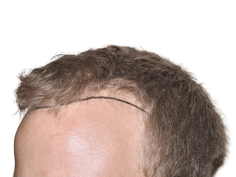 Hair transplant result: Before (thin) and after (fuller) hairline. Hair restoration procedure shown on Caucasian male.