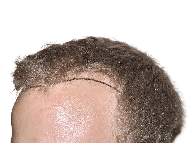 Hair transplant result: Before (thin) and after (fuller) hairline. Hair restoration procedure shown on Caucasian male.