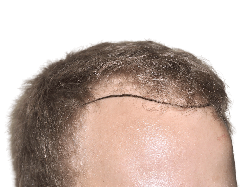 Hair transplant result: Close-up of hairline showing restored hair. Potential scar visible. Hair restoration procedure.