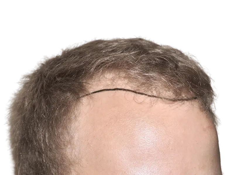 Hair transplant result: Close-up of hairline showing restored hair. Potential scar visible. Hair restoration procedure.