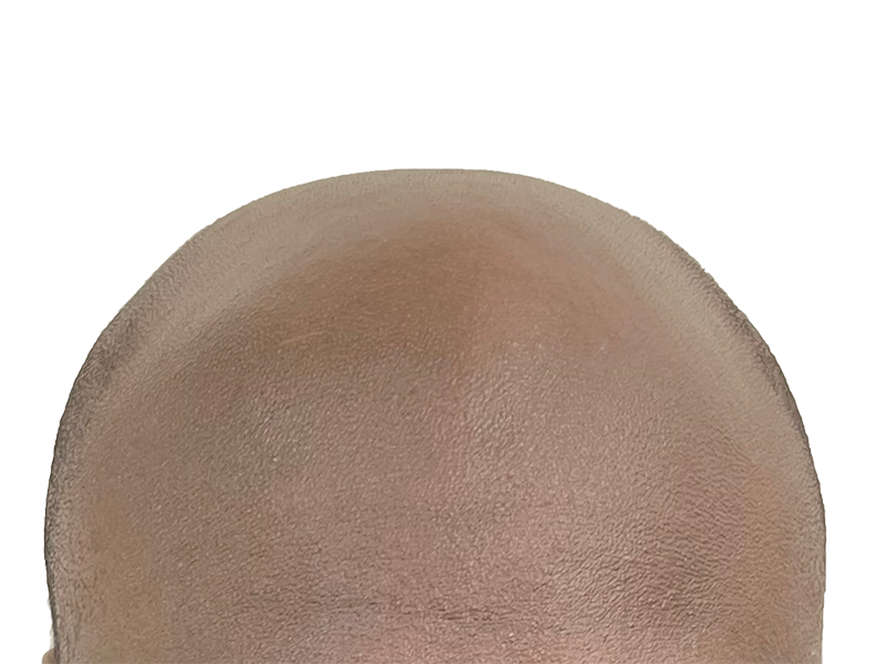 Bald head before hair restoration. Shows advanced hair loss. Consider hair transplant options for regrowth.