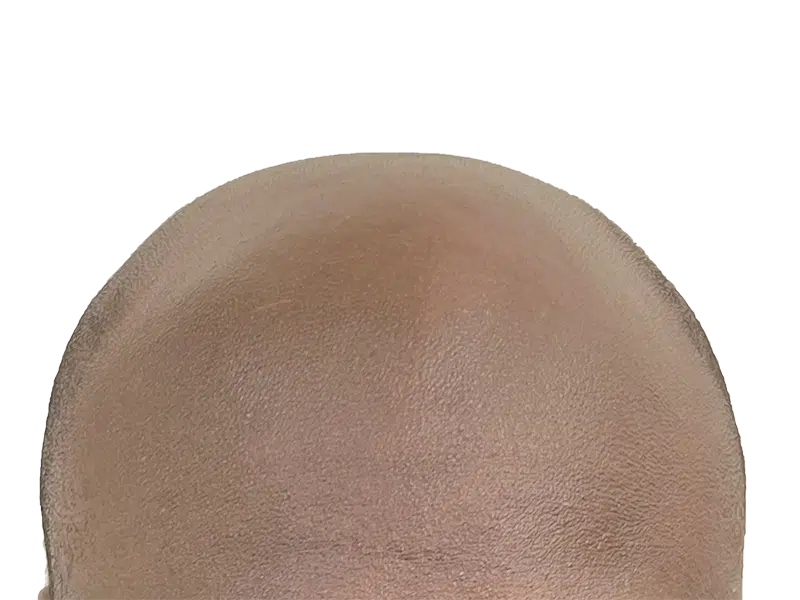 Bald head before hair restoration. Shows advanced hair loss. Consider hair transplant options for regrowth.