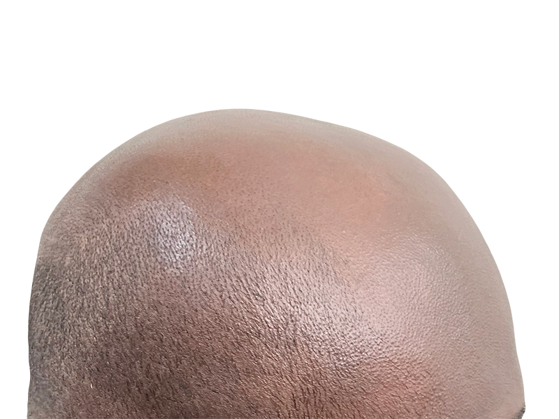 Bald African American man's head. Hair loss before hair restoration treatment. Shows scalp detail.