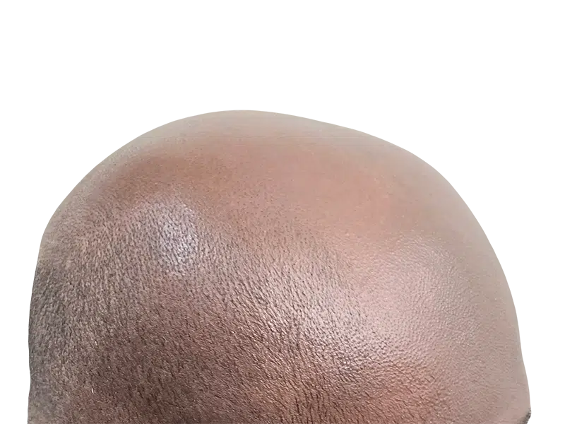 Bald African American man's head. Hair loss before hair restoration treatment. Shows scalp detail.