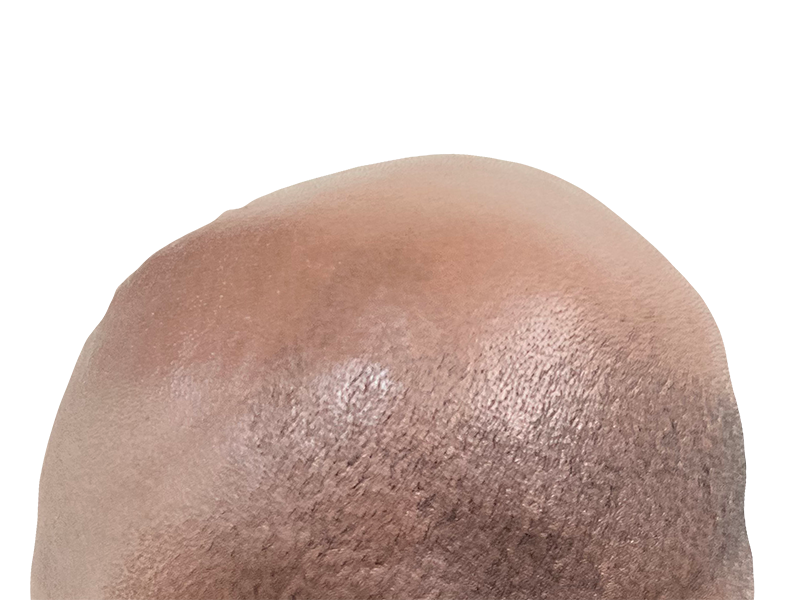 Receding hairline & thinning hair. Before hair restoration/transplant. Bald spot visible. Caucasian male.