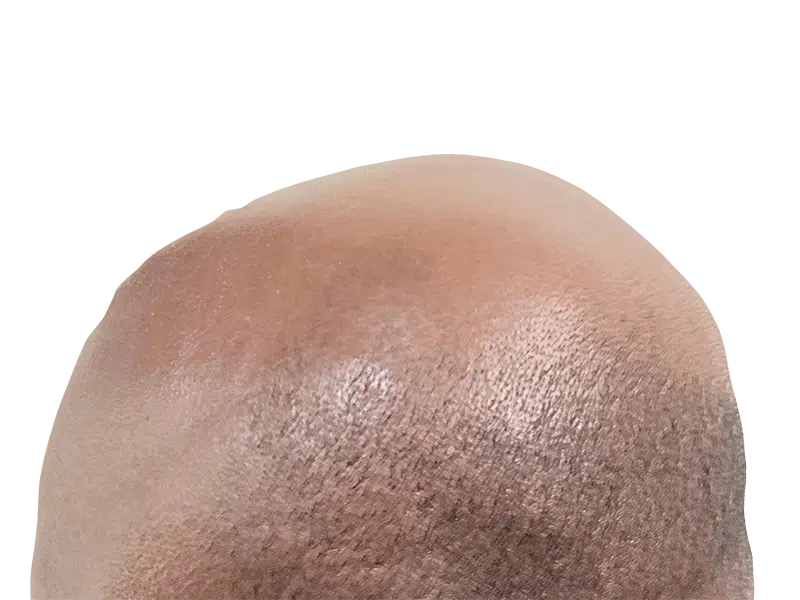 Receding hairline & thinning hair. Before hair restoration/transplant. Bald spot visible. Caucasian male.