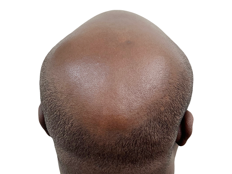 Hair restoration result: Bald spot on dark skin before potential hair transplant. Short hair on sides and back.
