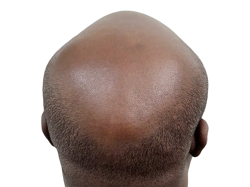 Hair restoration result: Bald spot on dark skin before potential hair transplant. Short hair on sides and back.