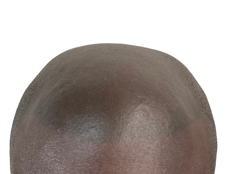 Close-up of scalp. Consider hair transplant options for thinning hair. Hair restoration consultation available.