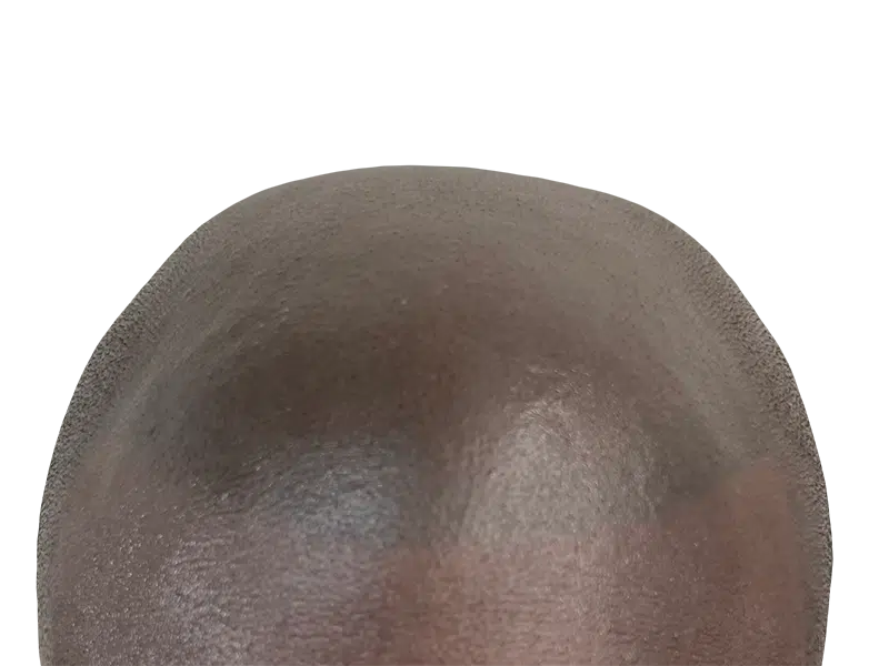 Close-up of scalp. Consider hair transplant options for thinning hair. Hair restoration consultation available.
