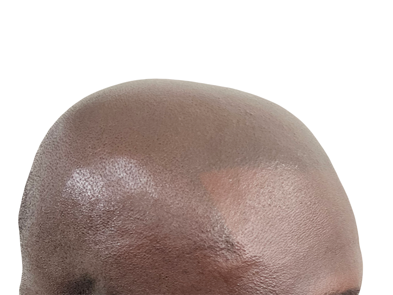 Close-up of scalp showing hair follicles. Potential hair restoration/transplant candidate. See before & after results.
