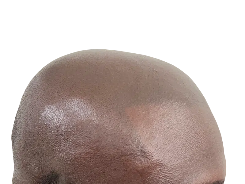 Close-up of scalp showing hair follicles. Potential hair restoration/transplant candidate. See before & after results.