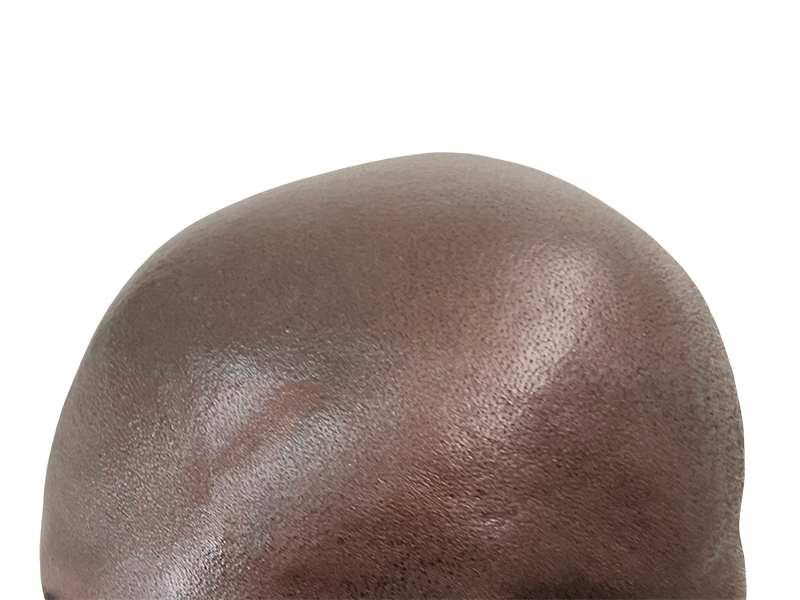 Bald African American man's head. Considering hair restoration or transplant? Before/after results unclear.