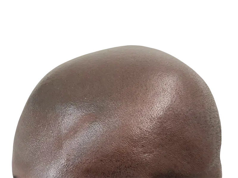 Bald African American man's head. Considering hair restoration or transplant? Before/after results unclear.