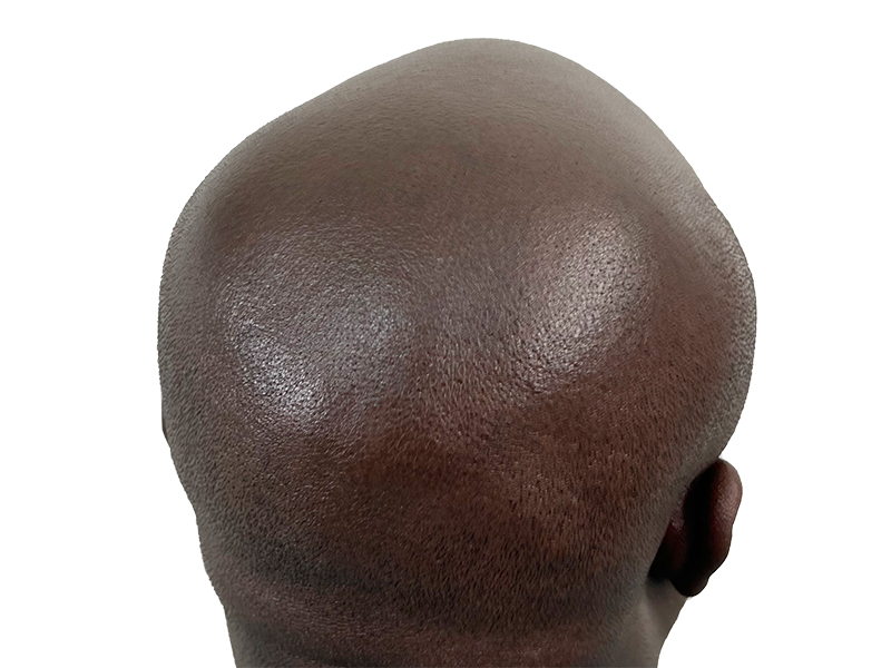 Before hair transplant: Bald African American man. Consider hair restoration options for similar results.