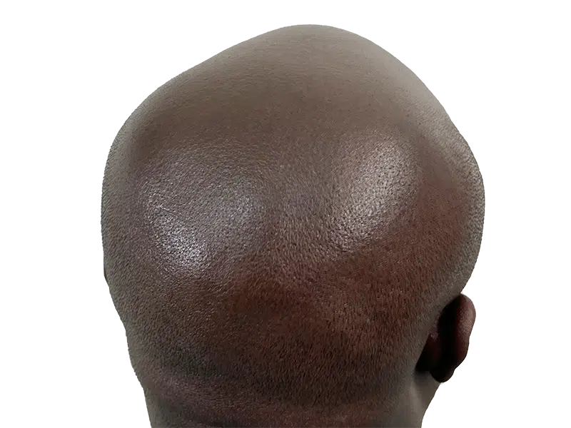 Before hair transplant: Bald African American man. Consider hair restoration options for similar results.