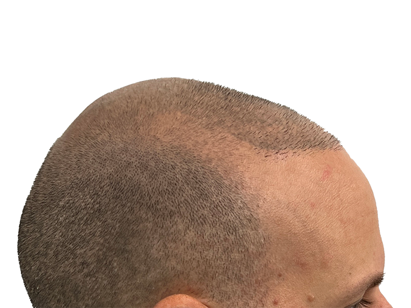 Hair transplant result: Fuller hairline achieved. Before & after hair restoration shown. Caucasian male, side view.