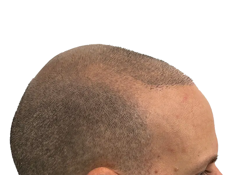 Hair transplant result: Fuller hairline achieved. Before & after hair restoration shown. Caucasian male, side view.