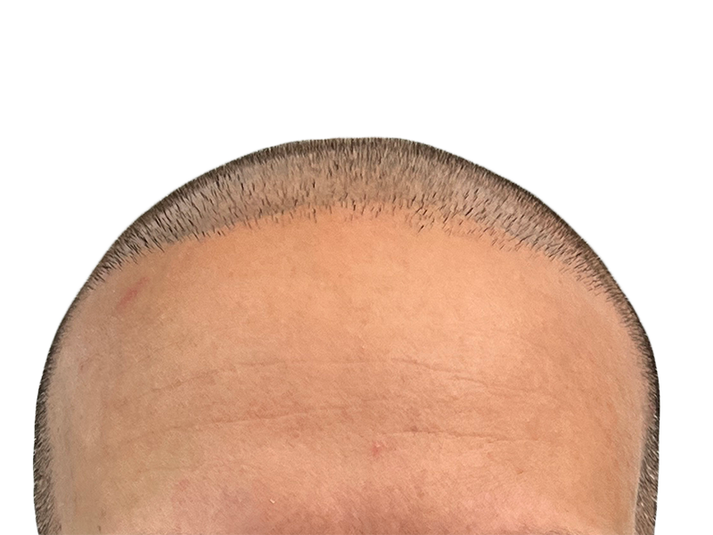 Hair transplant result: Close-up of hairline. Short hair, defined hairline suggests successful hair restoration procedure.