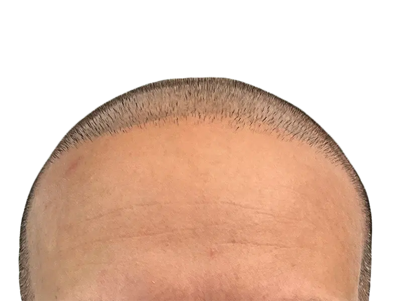 Hair transplant result: Close-up of hairline. Short hair, defined hairline suggests successful hair restoration procedure.