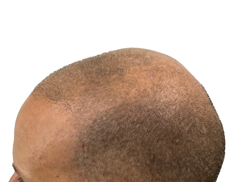 Thinning light brown hair on crown. Potential hair restoration candidate. Before hair transplant assessment.