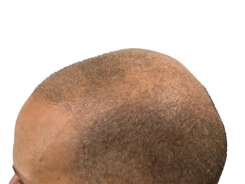 Thinning light brown hair on crown. Potential hair restoration candidate. Before hair transplant assessment.
