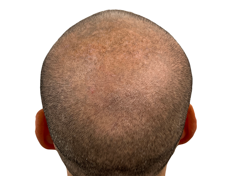 Thinning hair on crown. Possible hair loss. Consider hair restoration or transplant options. Before/After results may vary.