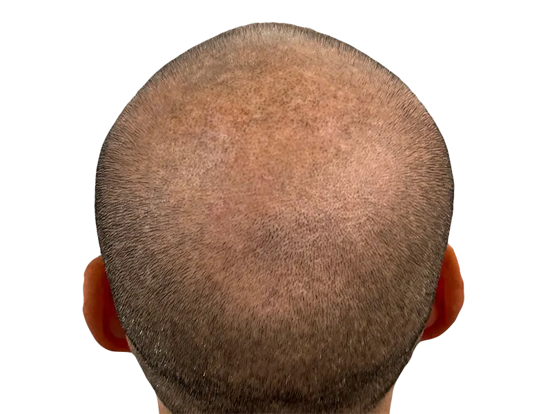 Thinning hair on crown. Possible hair loss. Consider hair restoration or transplant options. Before/After results may vary.