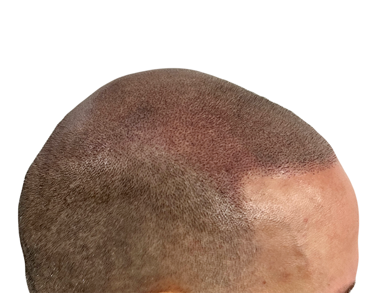 Hair transplant result: Natural, dense hairline restoration. Caucasian male. Before/after hair loss solution.