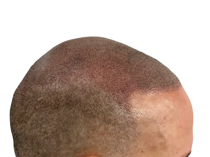 Hair transplant result: Natural, dense hairline restoration. Caucasian male. Before/after hair loss solution.