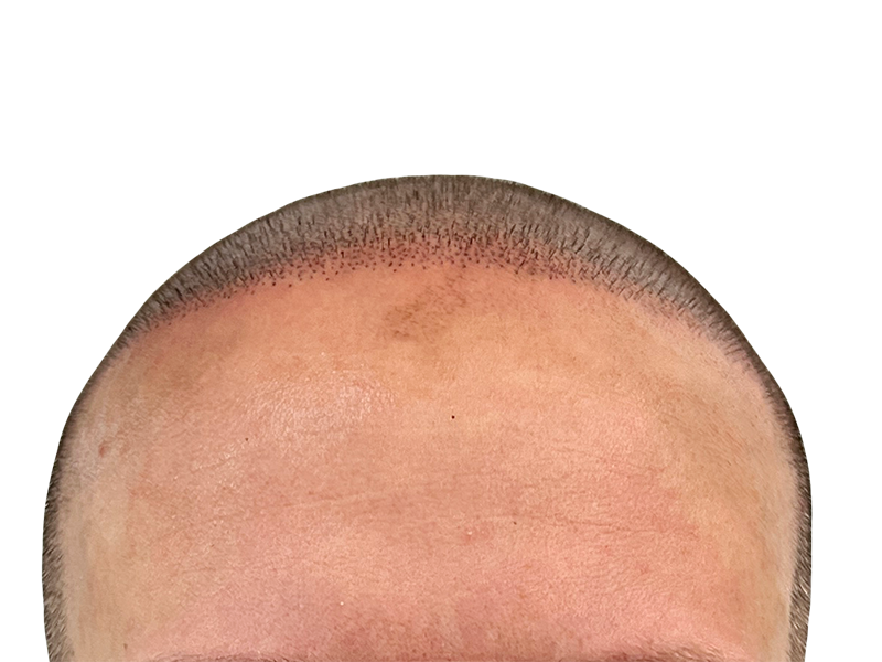 Hair transplant: Close-up of hairline showing new growth after procedure. Before & after hair restoration results.