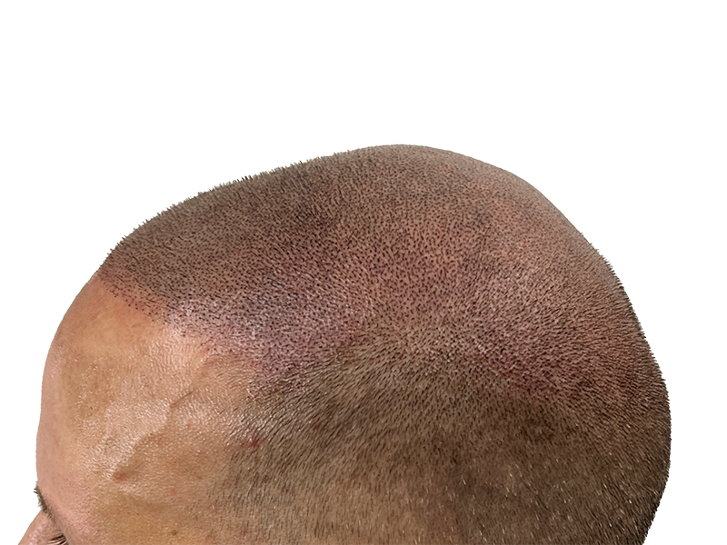 Hair restoration result: Close-up of scalp after hair transplant or SMP. Natural-looking hairline, fuller appearance.