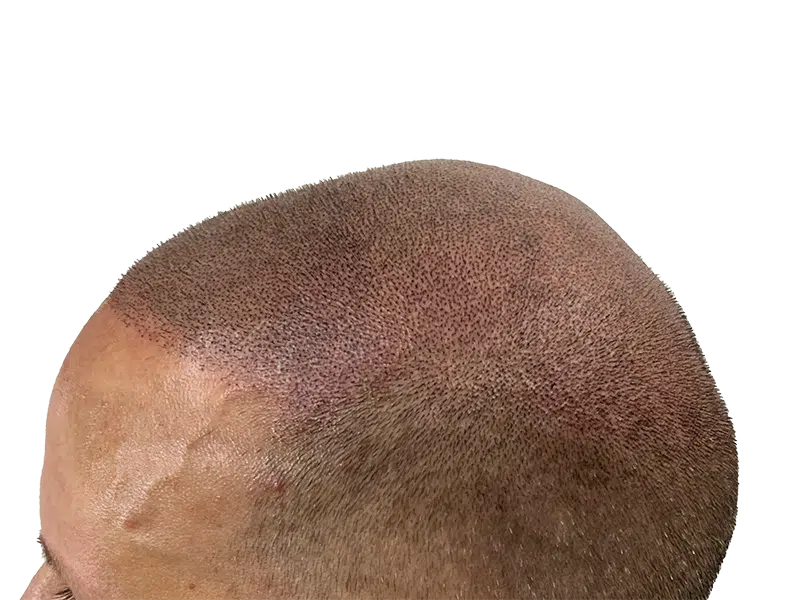 Hair restoration result: Close-up of scalp after hair transplant or SMP. Natural-looking hairline, fuller appearance.